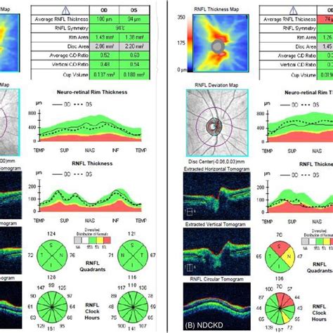 thickness measurement of retina|retinal thickness treatment.